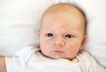Acne neonatale: cos’è, quanto dura, i rimedi Acne neonatale cos'è, quanto dura, i rimedi