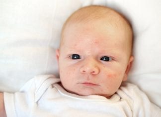 Acne neonatale: cos’è, quanto dura, i rimedi Acne neonatale cos'è, quanto dura, i rimedi