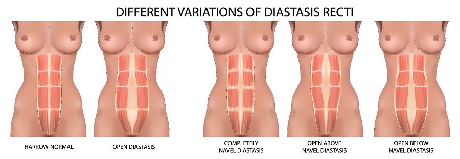 Diastasi addominale di cosa si tratta, sintomi e come curarla2