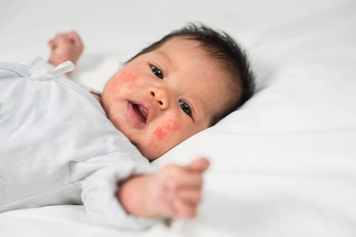 Dermatite del neonato cause, sintomi e rimedi