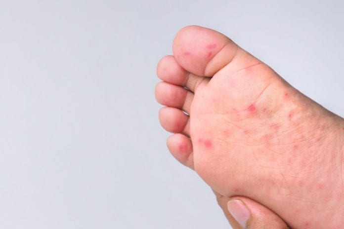 Malattia bocca mani piedi sintomi, rimedi e come riconoscerla