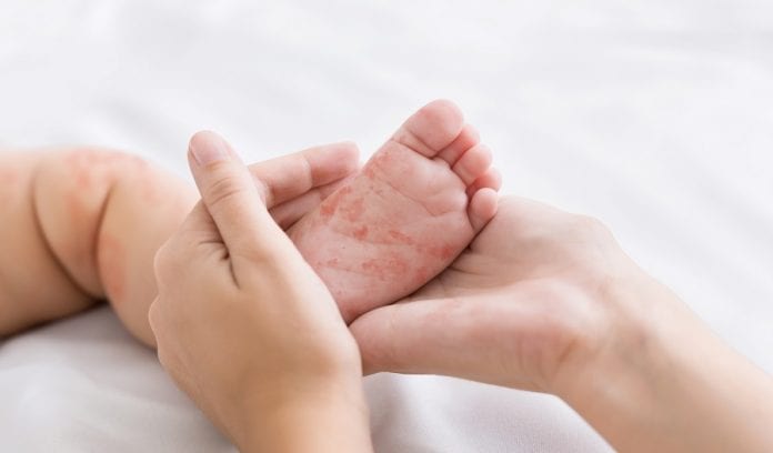 Ittiosi neonatale cause, sintomi e cure