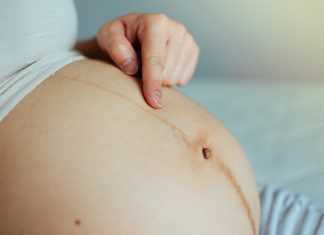 Linea nigra in gravidanza: cos’è e quando compare Linea nigra in gravidanza: cos'è e quando compare