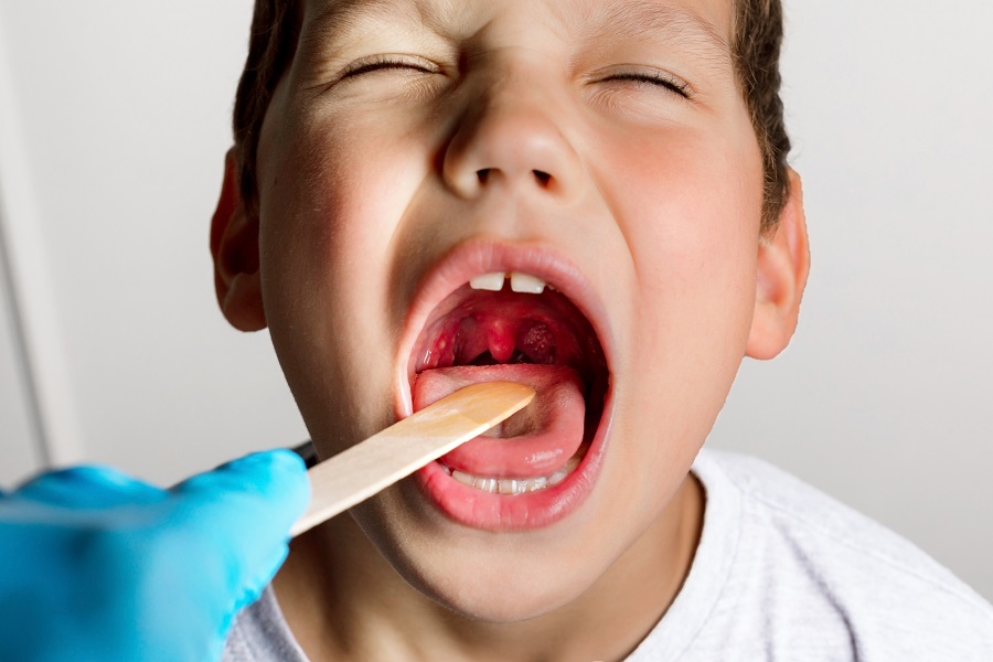 Bambini, tutto quello che c'è da sapere sulla tonsillite2