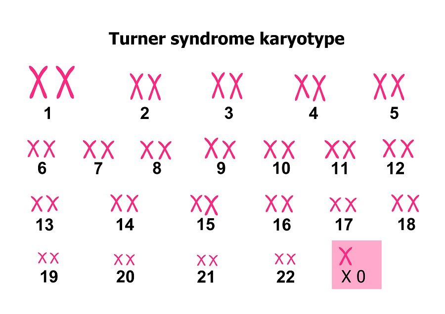 Sindrome di Turner, di cosa si tratta e quali sono i sintomi