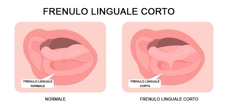 Frenulo linguale corto
