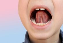 Frenulo linguale corto: di cosa si tratta e cosa sapere Frenulo linguale corto: di cosa si tratta e cosa sapere
