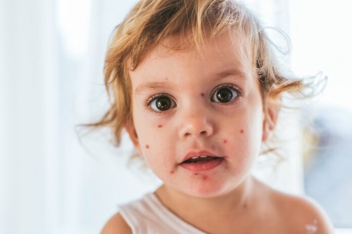 Varicella nei bambini: sintomi, cause e rimedi
